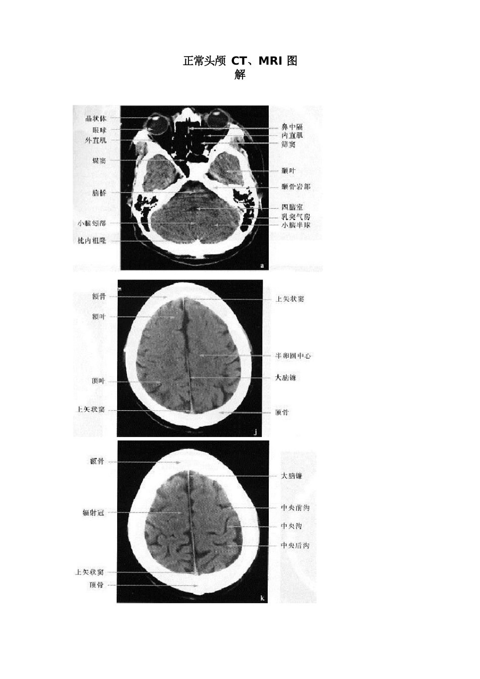 正常头部ct图谱_第1页