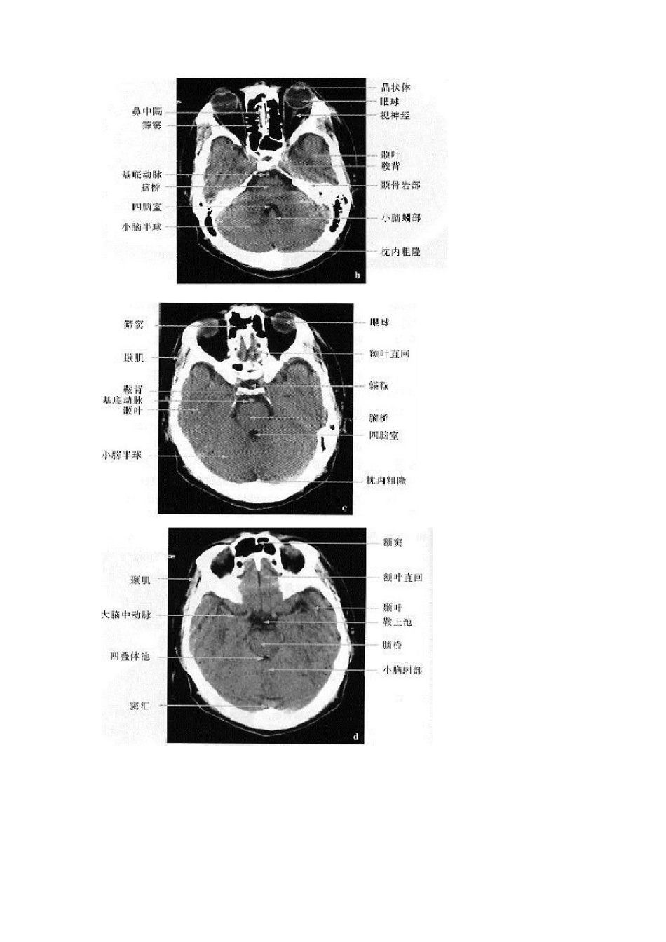 正常头部ct图谱_第2页