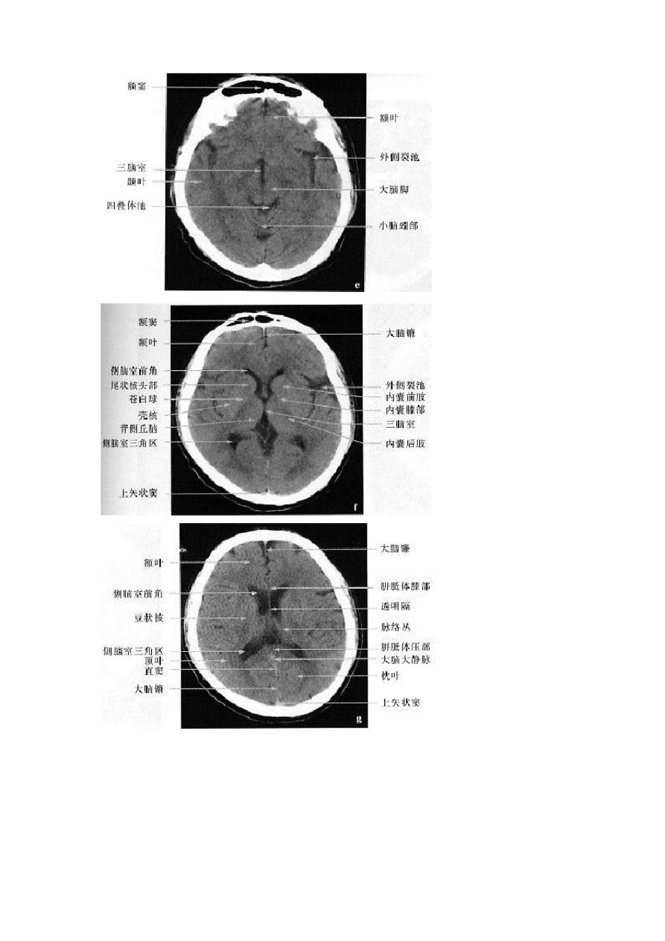 正常头部ct图谱_第3页