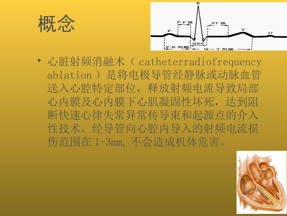 心脏射频消融术_第2页
