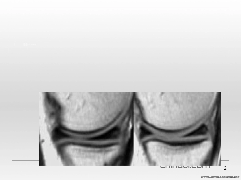 半月板的影像学表现[共46页]_第2页