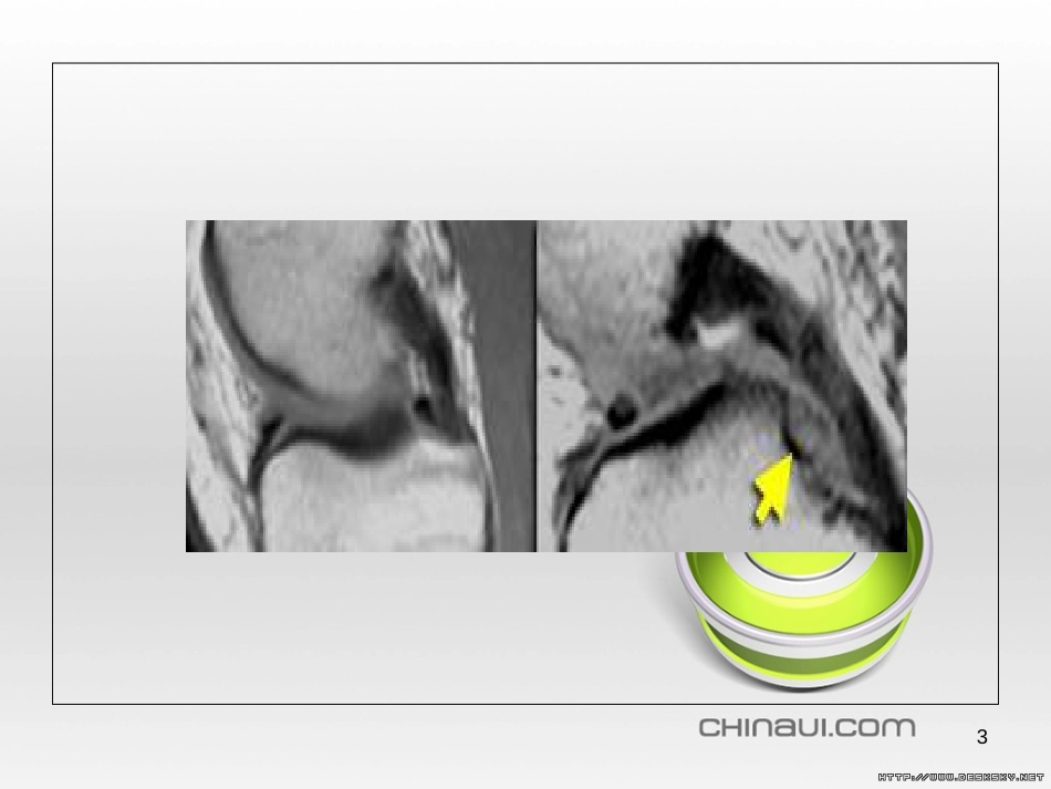 半月板的影像学表现[共46页]_第3页