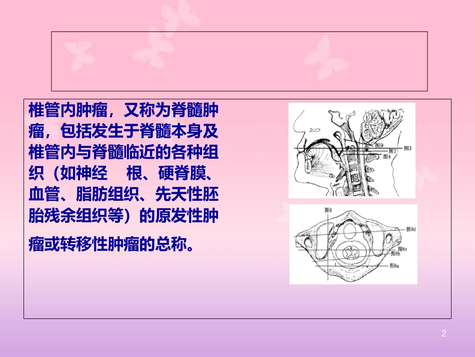 常见椎管内肿瘤及MRI表现[共30页]_第2页