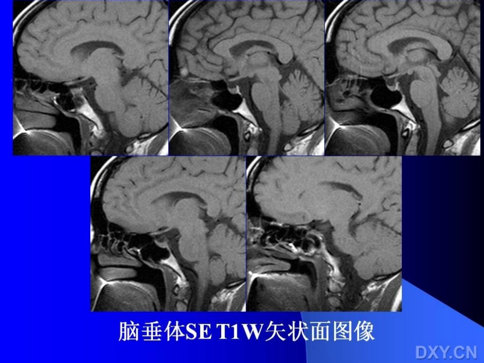 垂体瘤MR表现[共67页]_第3页