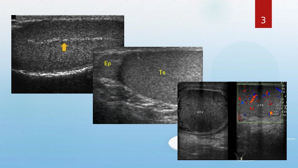 睾丸及附件扭转超声表现[共29页]_第3页