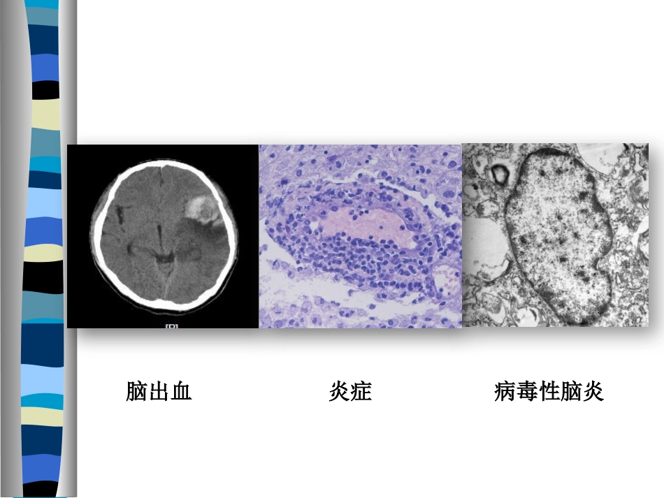 病毒性脑炎诊断的困惑_第2页