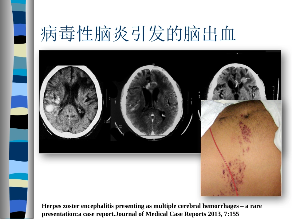 病毒性脑炎诊断的困惑_第3页