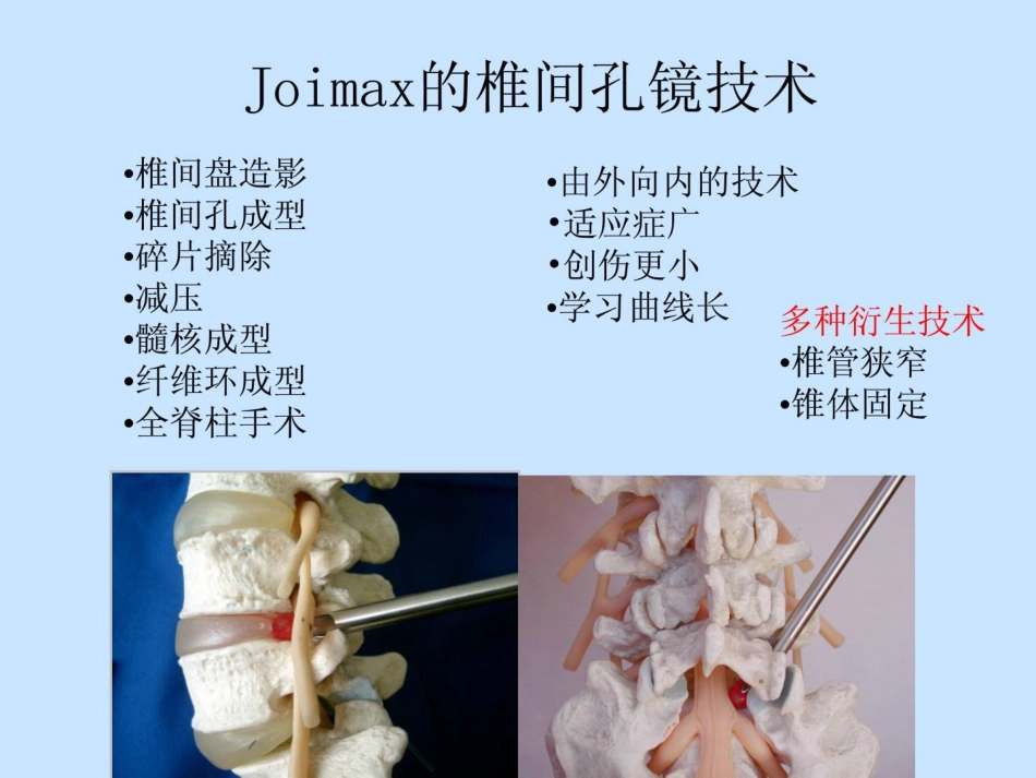 joimax椎间孔镜技巧临床医学医药卫生专业资料_第2页