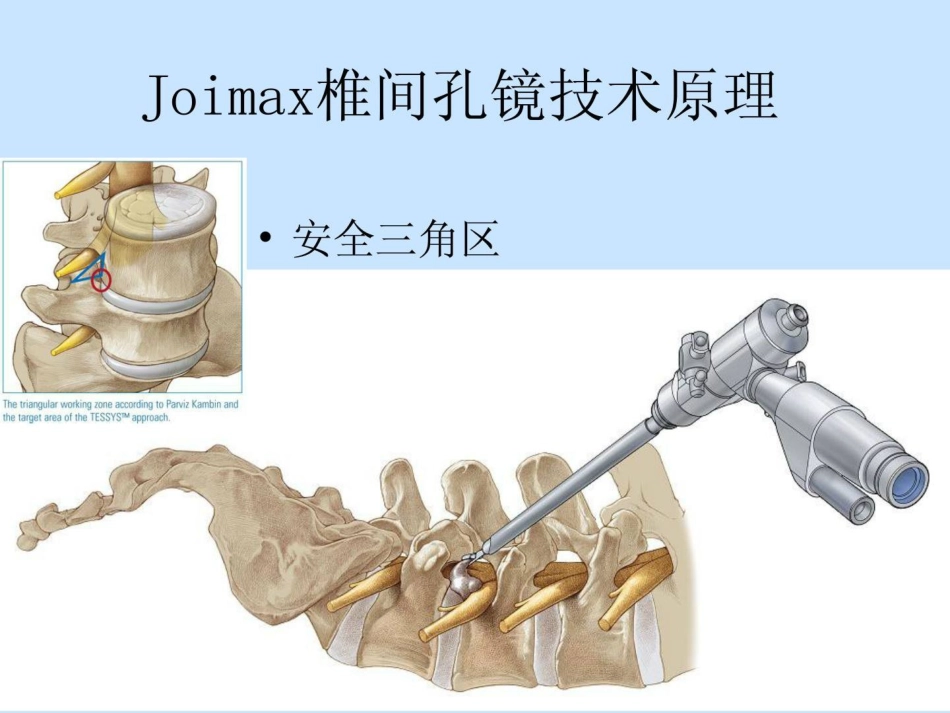 joimax椎间孔镜技巧临床医学医药卫生专业资料_第3页