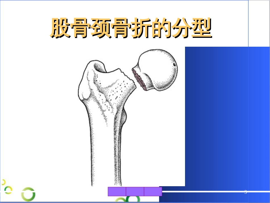 髋部骨折的分型ppt课件[共27页]_第3页