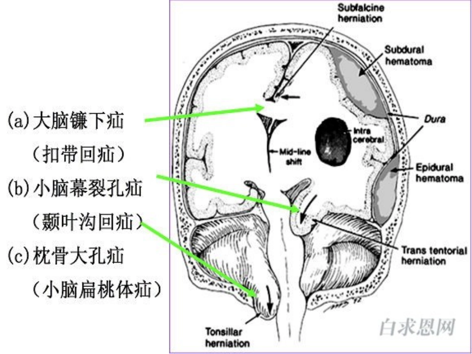 脑疝的临床表现及[共9页]_第3页