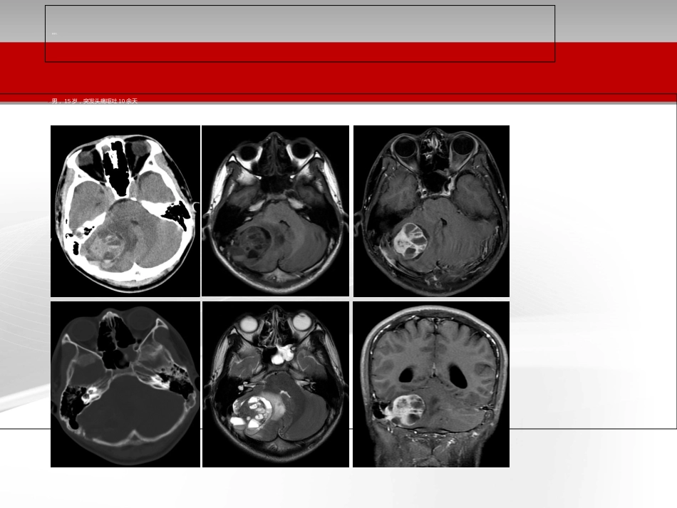 颅骨肿瘤影像学表现[共33页]_第2页