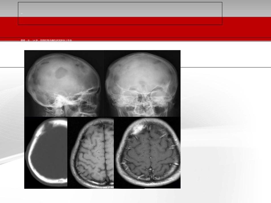 颅骨肿瘤影像学表现[共33页]_第3页