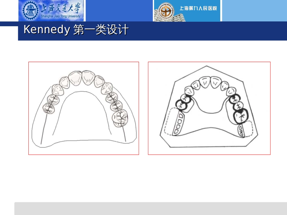 活动义齿(设计)[40页]_第3页