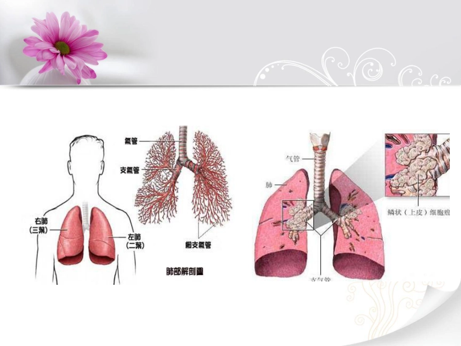 肺癌个案护理查房(共26页)_第3页