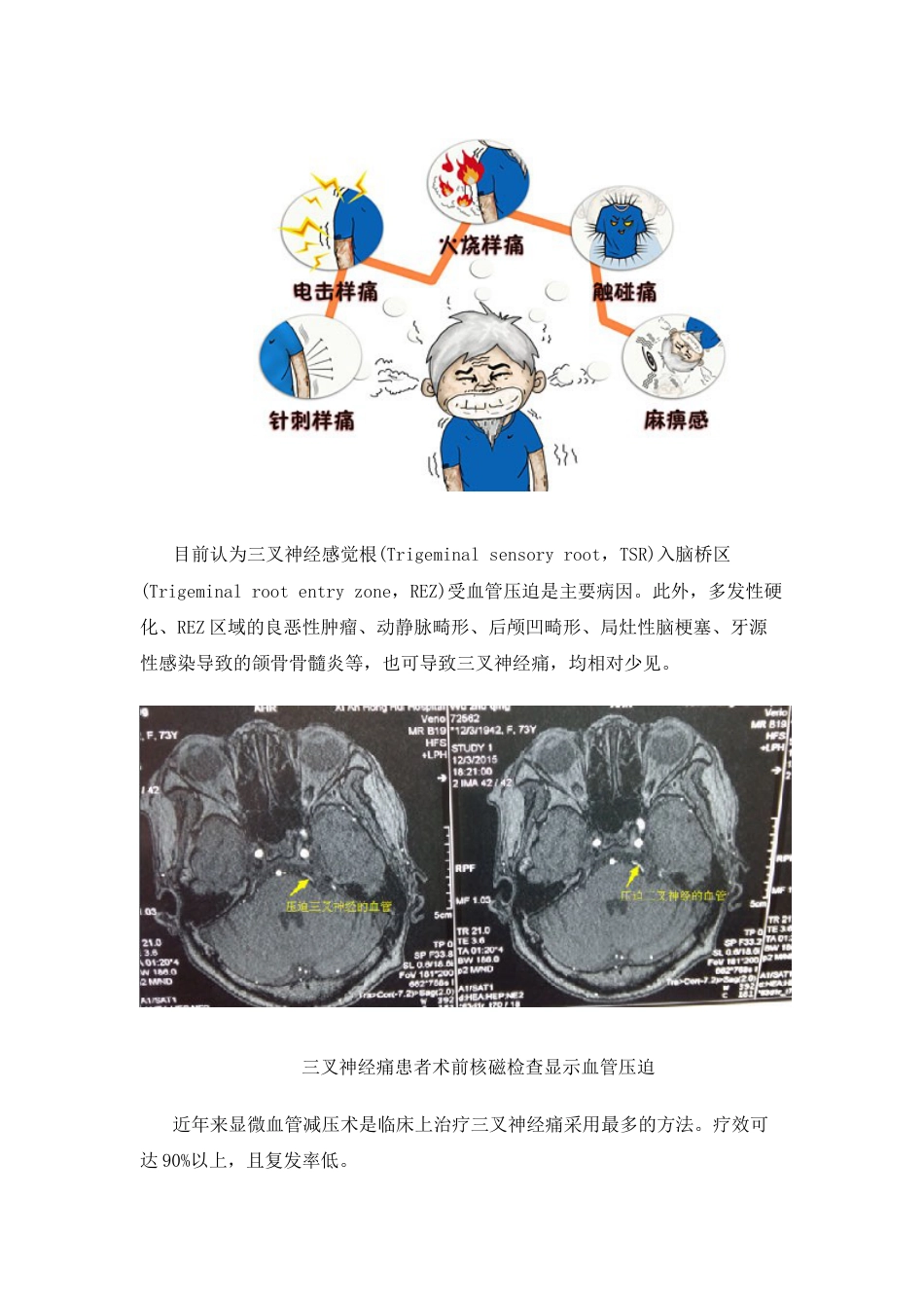 图解微血管减压手术治疗三叉神经痛的过程[8页]_第2页