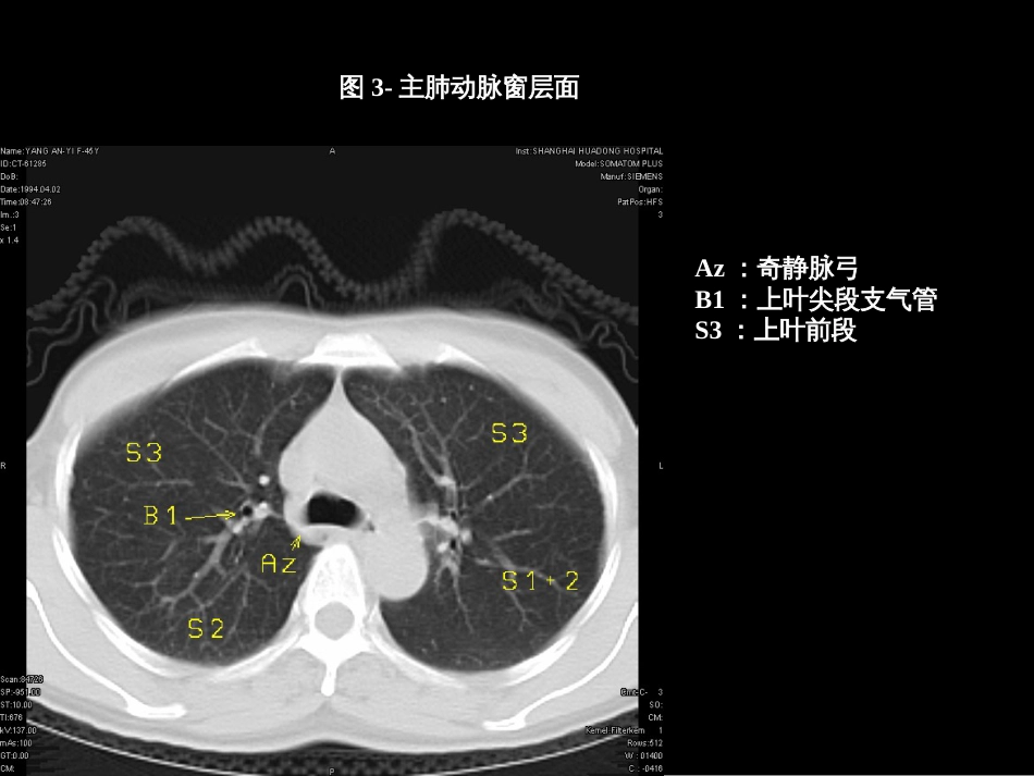 肺叶分段段ct(共页)_第3页