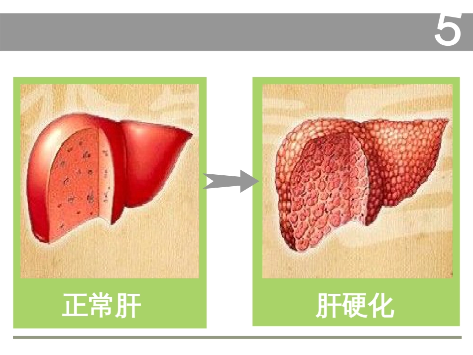 肝硬化（共68页）_第3页