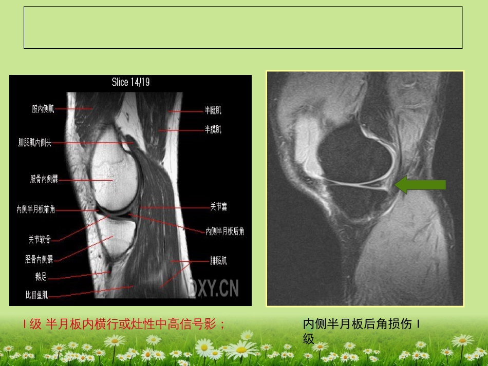 膝关节韧带MRI损伤表现[共39页]_第2页