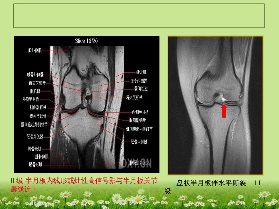 膝关节韧带MRI损伤表现[共39页]_第3页