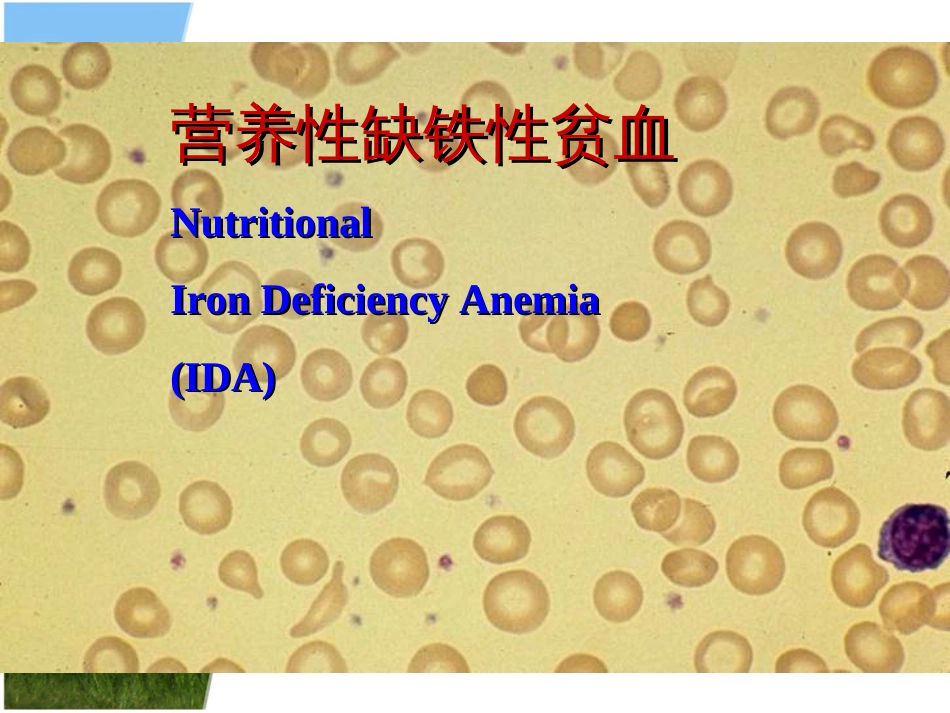 营养性缺铁性贫血[共26页]_第1页