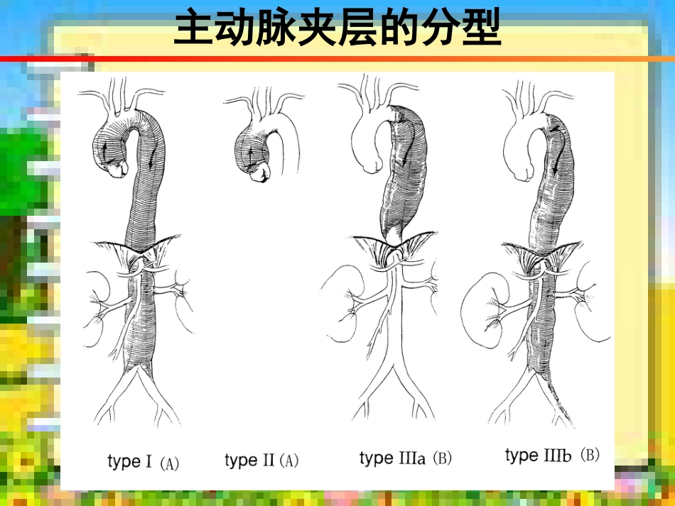 主动脉夹层外科治疗[共37页]_第2页