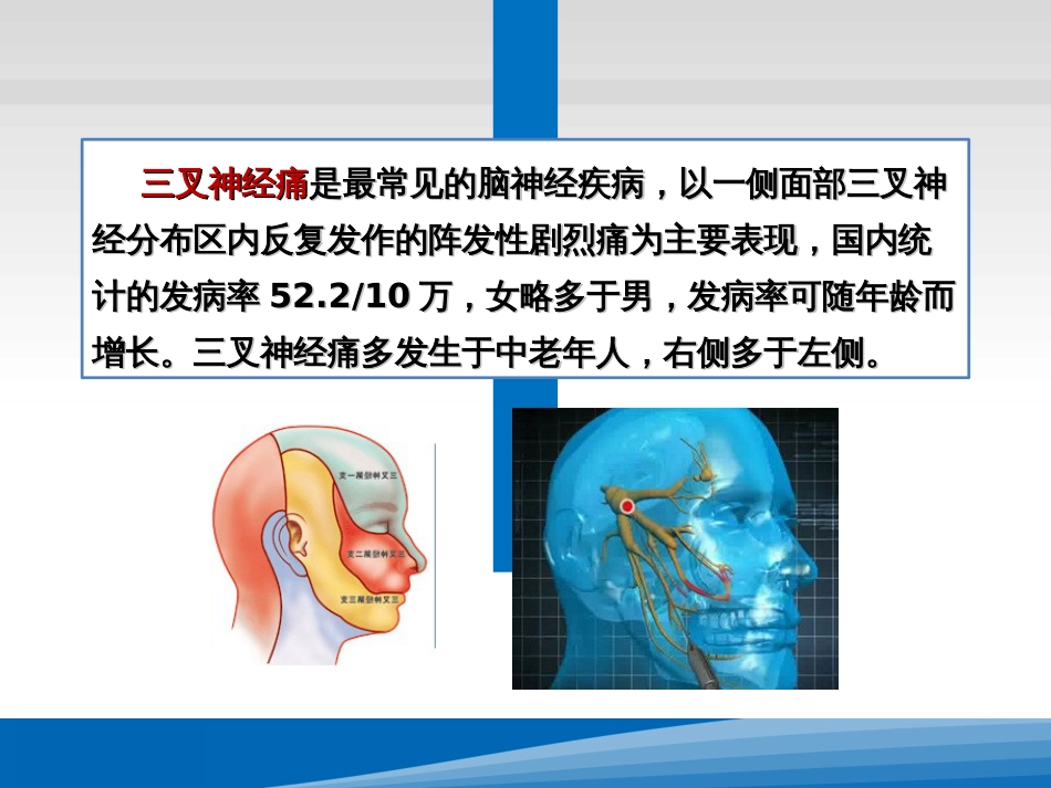 三叉神经痛的基本知识ppt课件[23页]_第3页