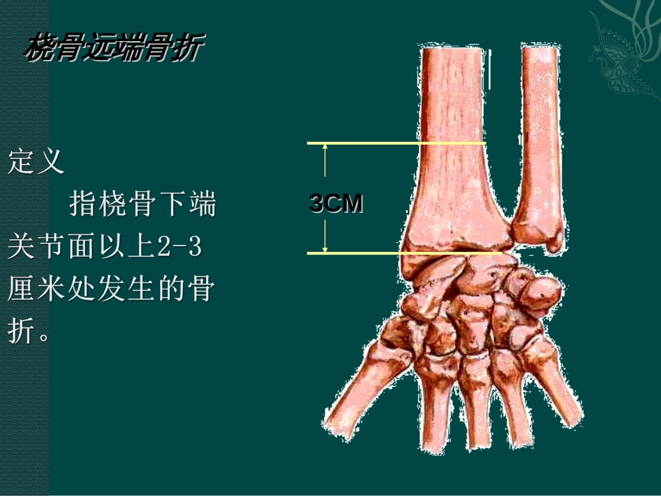 桡骨远端骨折课件[43页]_第2页