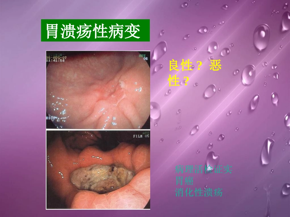 内镜诊断中有关病理问题讲义_第3页