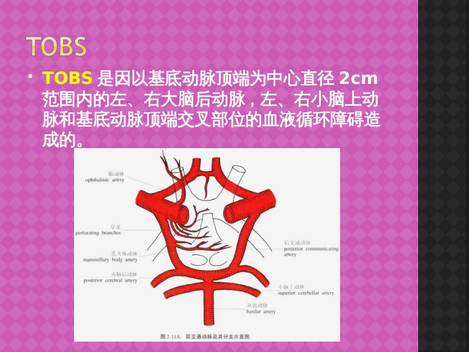 基底动脉尖综合征[18页]_第3页