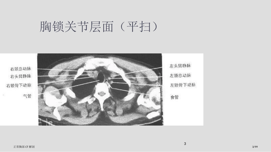 正常胸部CT解剖_第3页