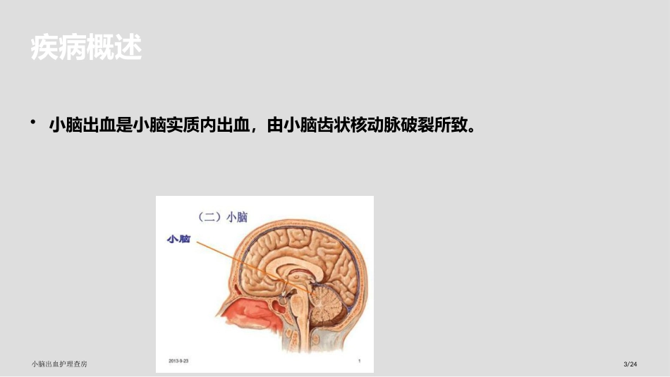 小脑出血护理查房_第3页