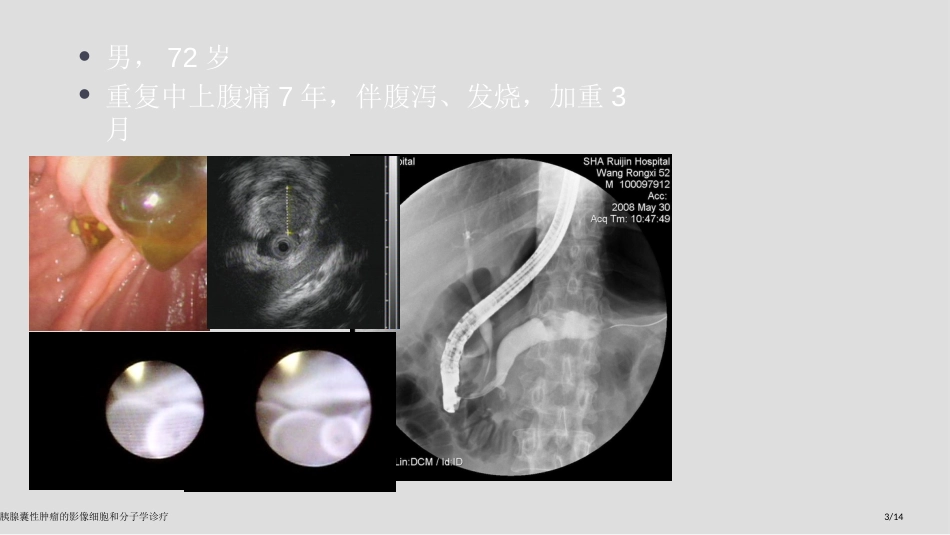 胰腺囊性肿瘤的影像细胞和分子学诊疗_第3页