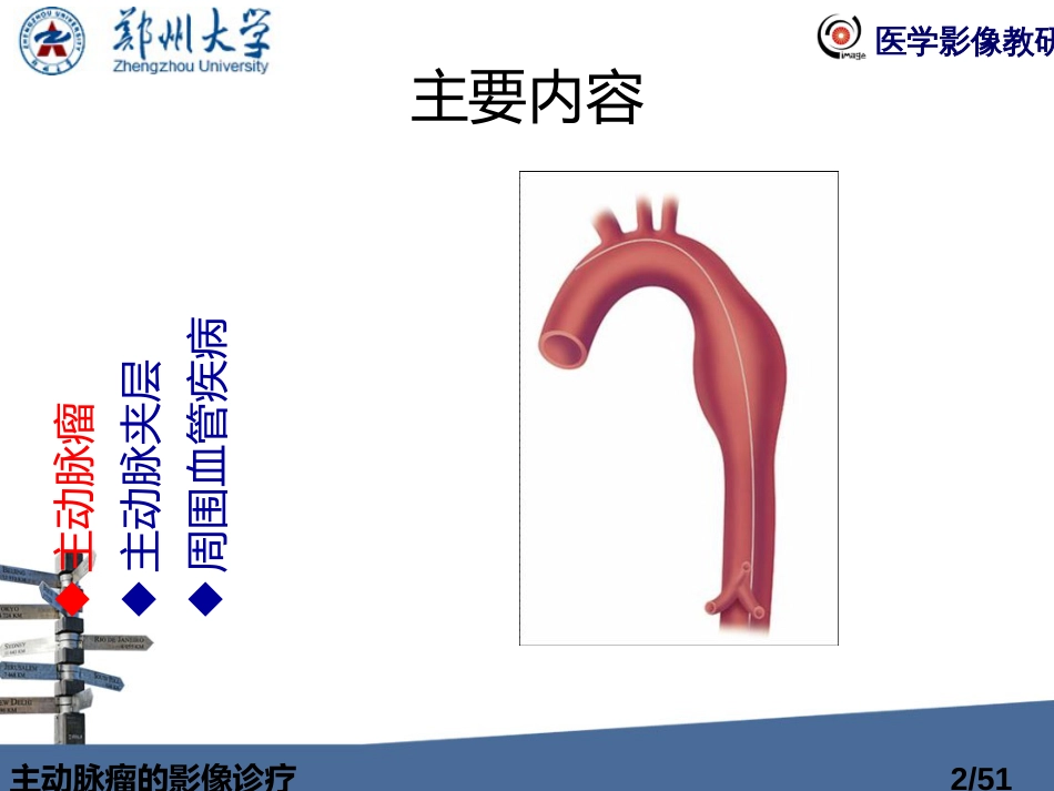 主动脉瘤的影像诊疗_第2页