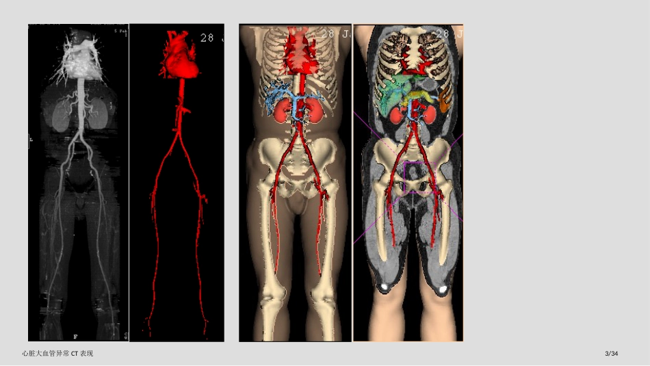 心脏大血管异常CT表现_第3页