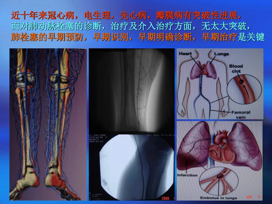 肺栓塞的诊断及介入治疗[109页]_第2页