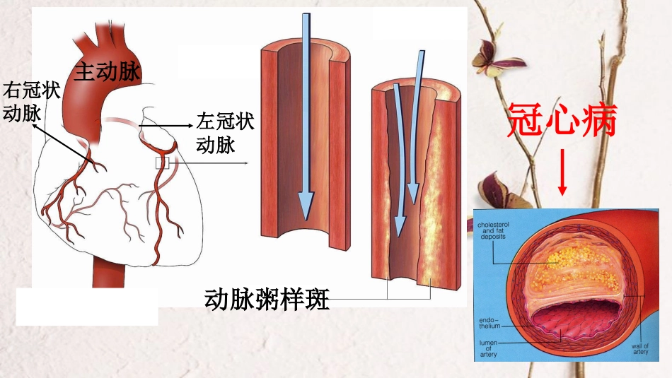 北京市中考生物 疾病与健康-冠心病课件_第2页