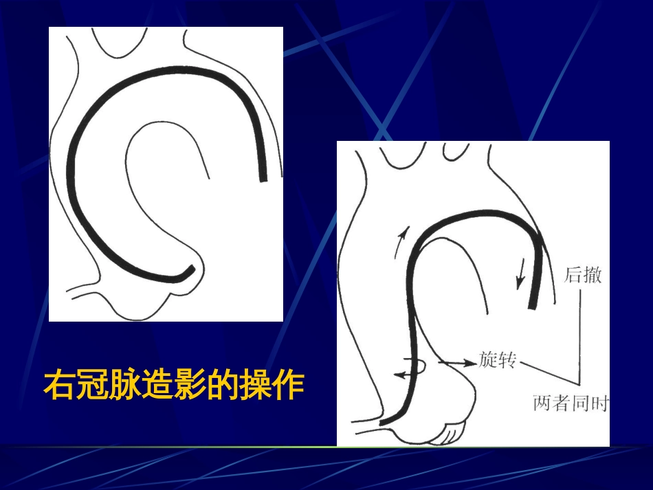 冠脉造影术简装板绝好资料_第3页