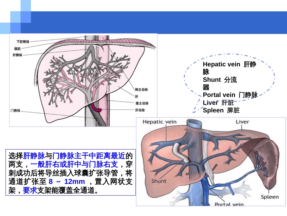 TIPS护理[共15页]_第3页