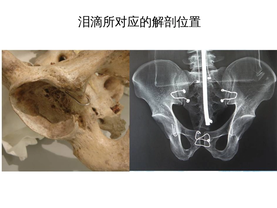 全髋关节置换术中的精确重建[共70页]_第3页