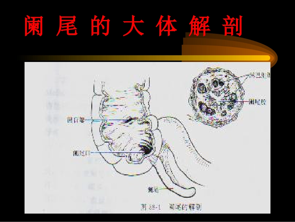 阑尾炎、腹部教学幻灯[共74页]_第2页