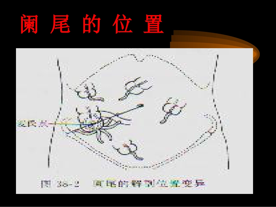 阑尾炎、腹部教学幻灯[共74页]_第3页