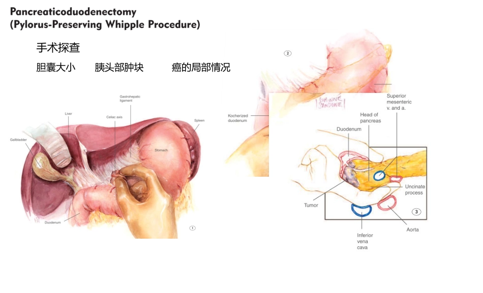 胰十二指肠切除术术式图解2010[14页]_第3页