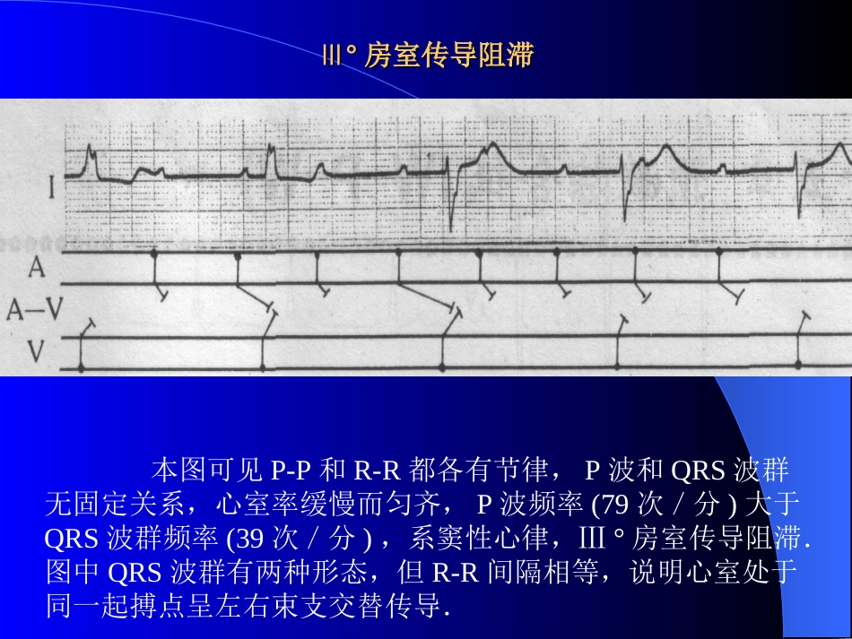 Ⅲ度房室传导阻滞_第1页