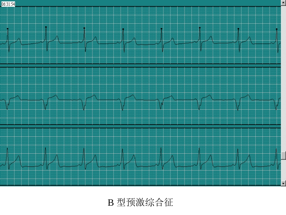 B型预激综合征_第1页