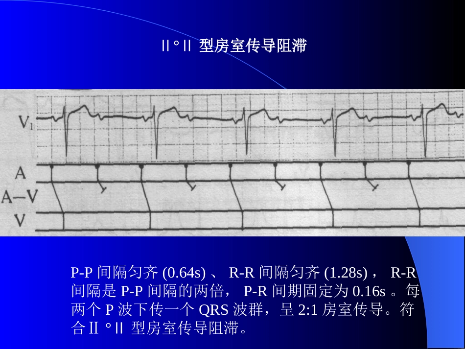 Ⅱ°Ⅱ型房室传导阻滞_第1页