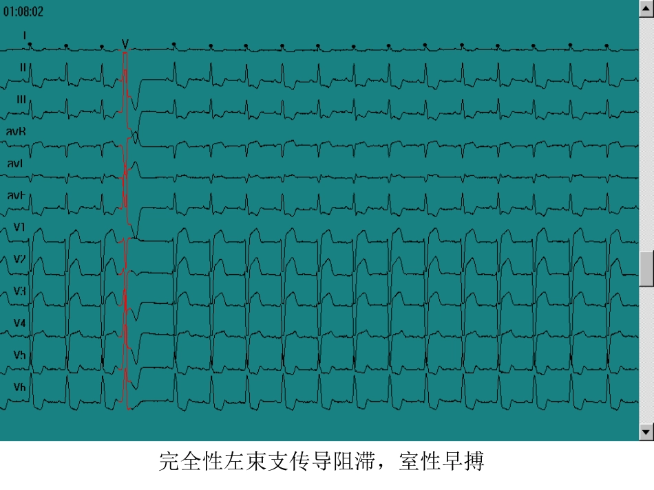 完全性左束支传导阻滞，VE[共1页]_第1页