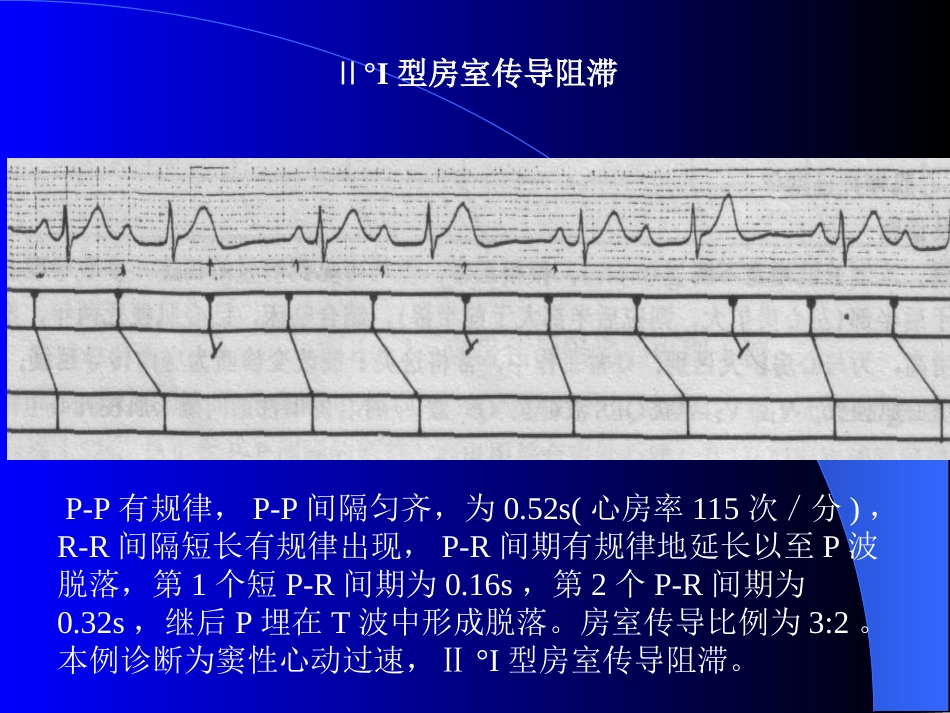 Ⅱ°I型房室传导阻滞_第1页