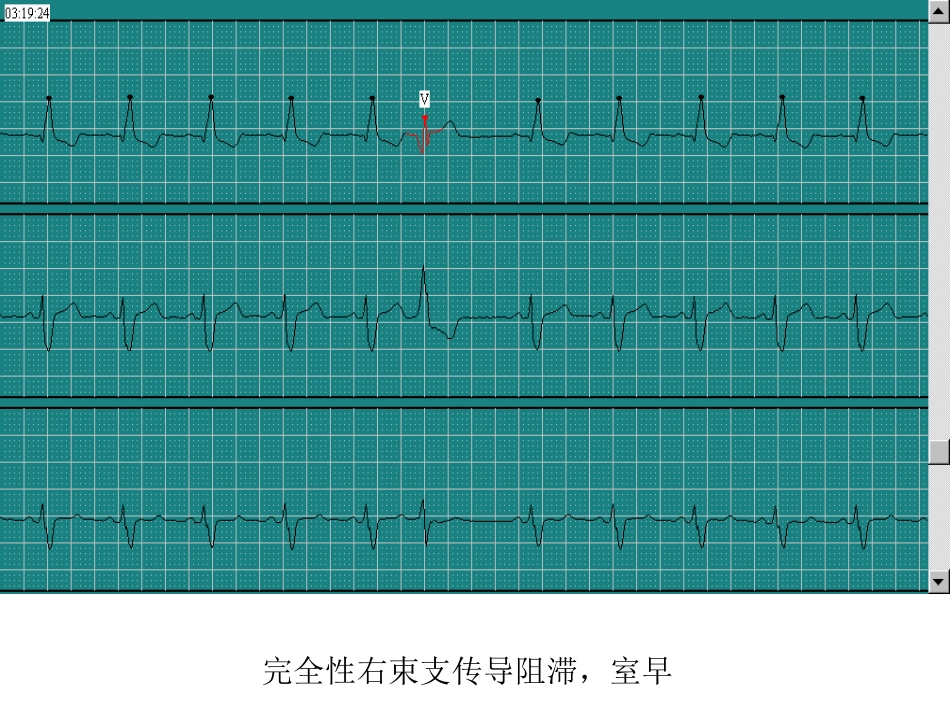 完全性右束支传导阻滞，VE[共1页]_第1页