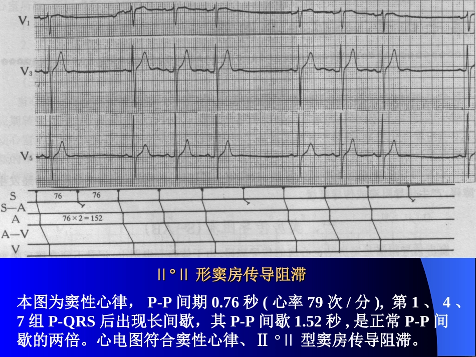 Ⅱ°Ⅱ型窦房传导阻滞_第1页